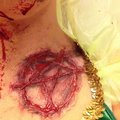 Brännmärkt Tingeling. Har använt flytande latex, toalettpapper, transparent puder, blod och hudlim för att fästa på kroppen.